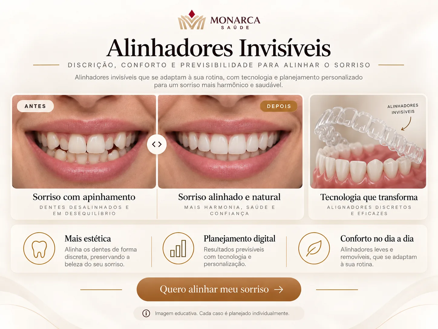 Exemplo visual educativo — Alinhadores Invisíveis