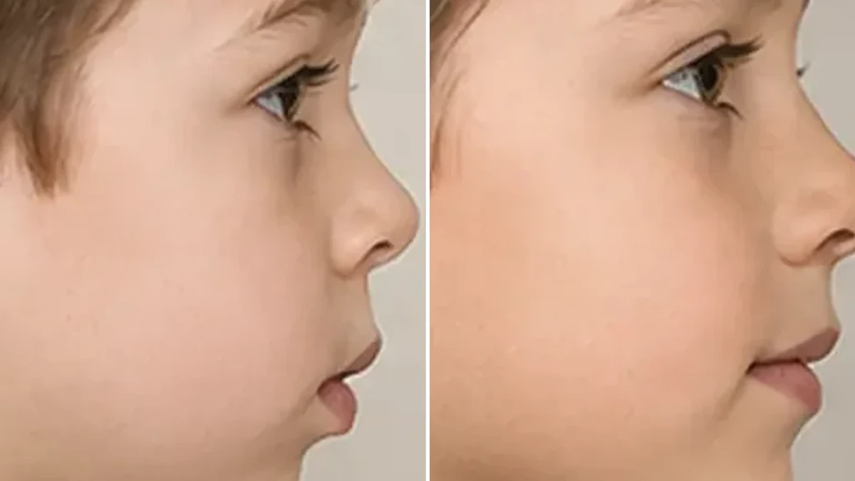 Crescimento Facial e Ortopedia