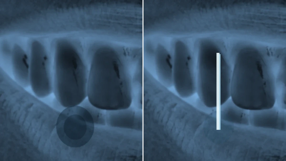 Canal / Endodontia