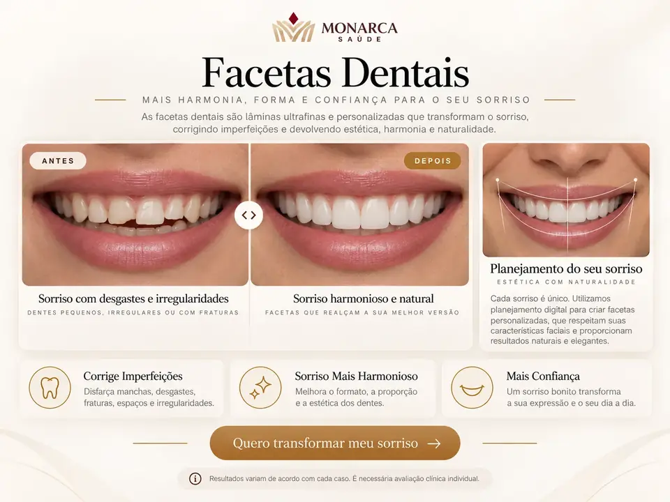 Guia visual — Facetas Dentárias