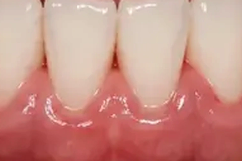Exemplo visual educativo depois de Periodontia