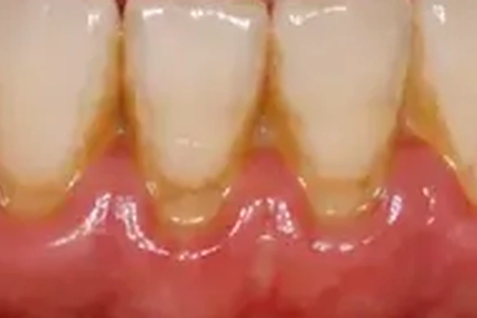 Exemplo visual educativo antes de Periodontia