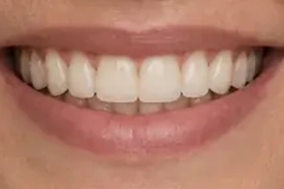 Depois - exemplo educativo de Prótese Dentária