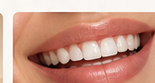 Facetas Dentárias