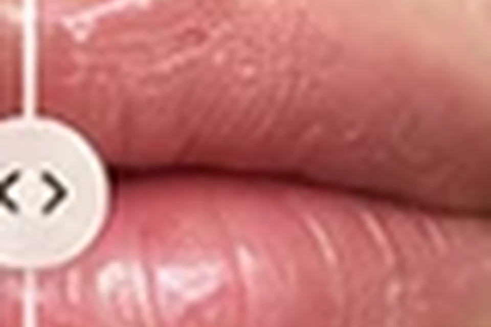 Exemplo visual educativo depois de Preenchimento Labial