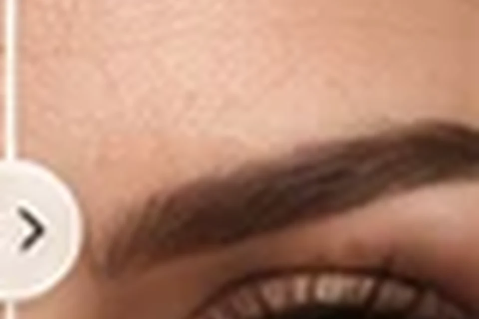 Depois - exemplo educativo de Toxina Botulínica (Botox)