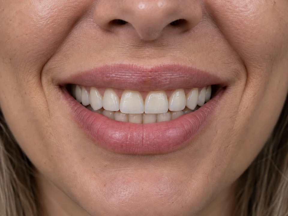 Exemplo visual educativo depois de Coroa Dentária