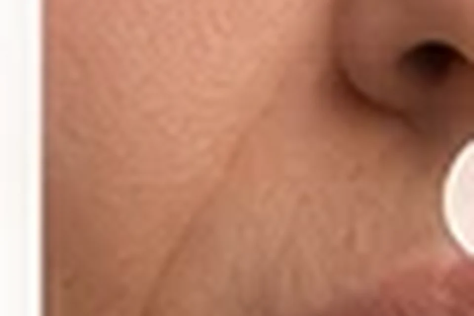 Exemplo visual educativo antes de Preenchimento do Sulco Nasogeniano (Bigode Chinês)