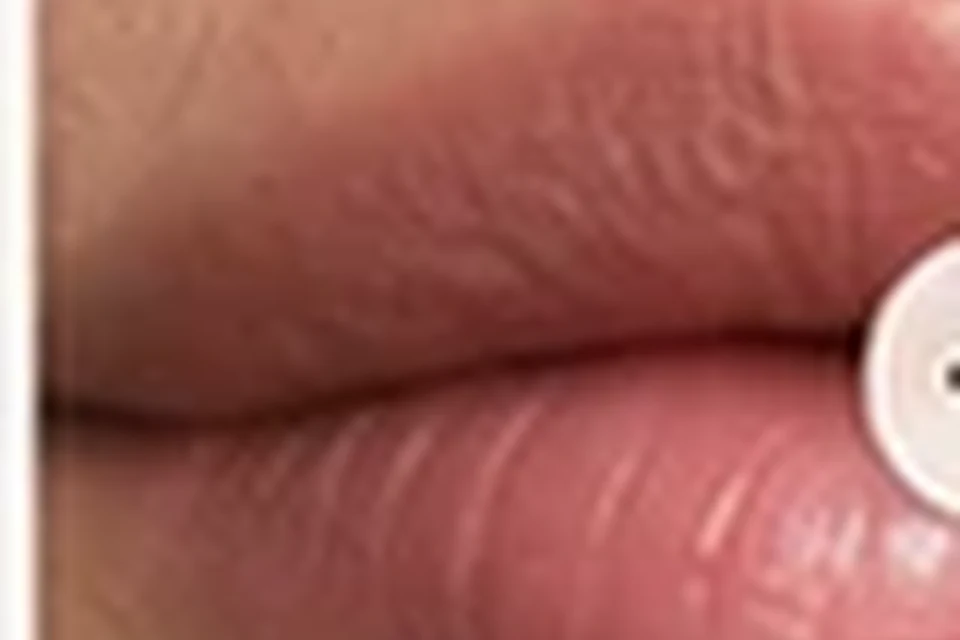 Exemplo visual educativo antes de Preenchimento Labial